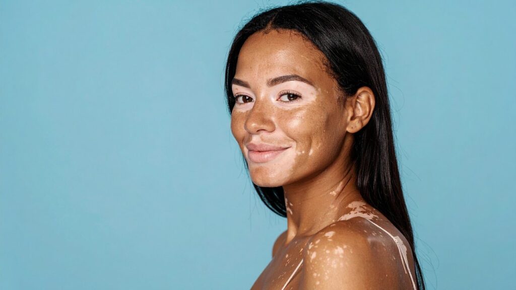 World Vitiligo Day